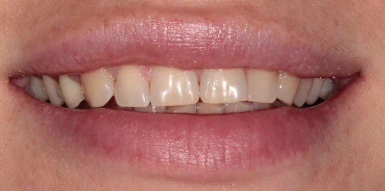 Отбеливание зубов: до лечения